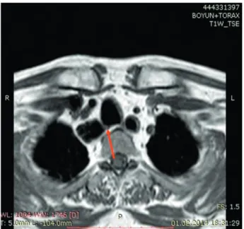 FIGURE 1. Thoracic magnetic resonance imaging revealed med- med-iastinal cystic lesions communicating with the trachea (arrowhead indicates the fistula tract).