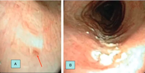 FIGURE 3. (A) Bronchoscopic appearance of the approximately 1-mm fistula opening 6 cm distal to the cricoid cartilage (arrow)