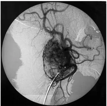 Figure 1.  Digital  subtraction  angiography  shows  a  giant 