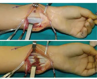 Şekil 6. Yüzeyel fleksör tendonların derin fleksör tendon- tendon-lara transferi. Ameliyat öncesi (üst sıra) ve  sonra-sı (alt sonra-sıra) görünüm.