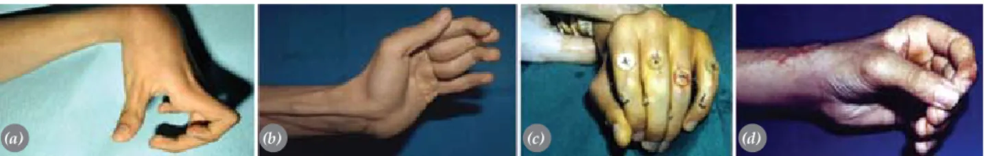 Fig. 10.  Correction of swan neck deformity with the sublimis tenodesis technique. (a) The preoperative view of the  13-year-old child with severe spasticity in the left hand