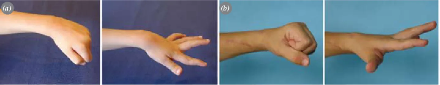 Fig. 11.  Reinforcement of the thumb abductor and extensor tendons: (a) Preoperative and (b) late postoperative appearance  of the patient.