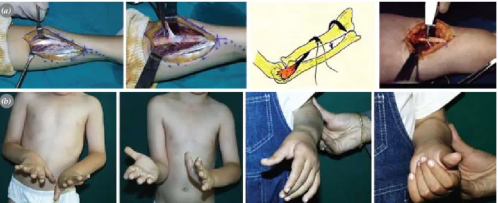 Fig. 2.  Pronator teres re-routing. (a) Surgical technique: While the forearm is brought to maximum supination, the prona- prona-tor insertion at the mid-1/3 radius is palpated
