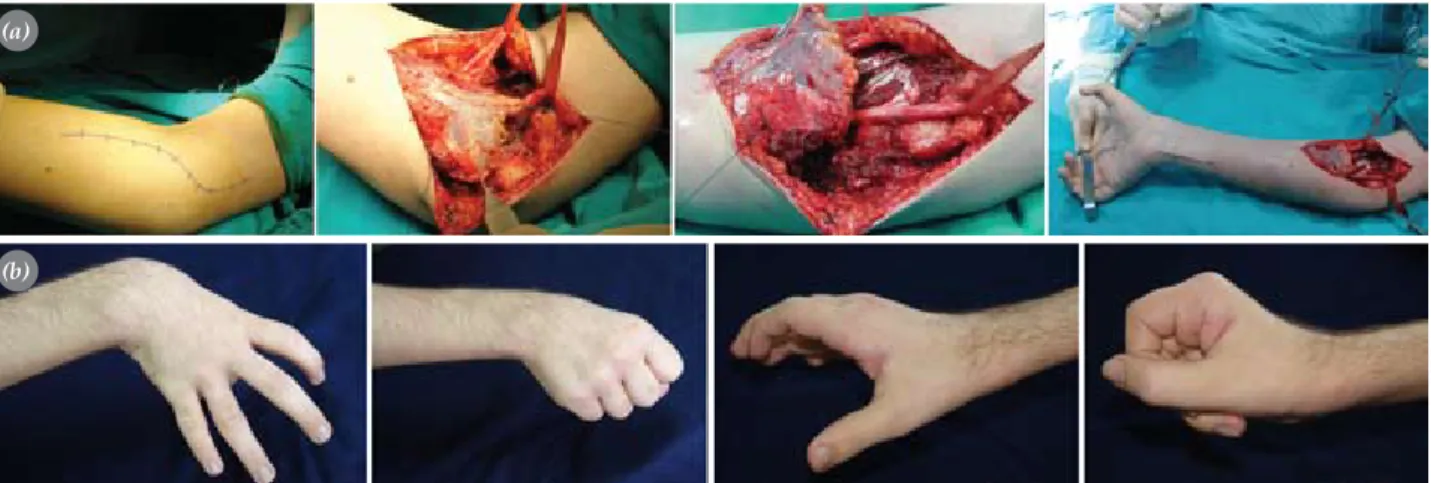 Fig. 7. Flexor/Pronator  slide.  (a) Surgical technique. (b) Case: Preoperative (first 2 pictures on the left) and postoperative  (last 2 pictures on the right) views of the patient with spasticity in the wrist and fingers.
