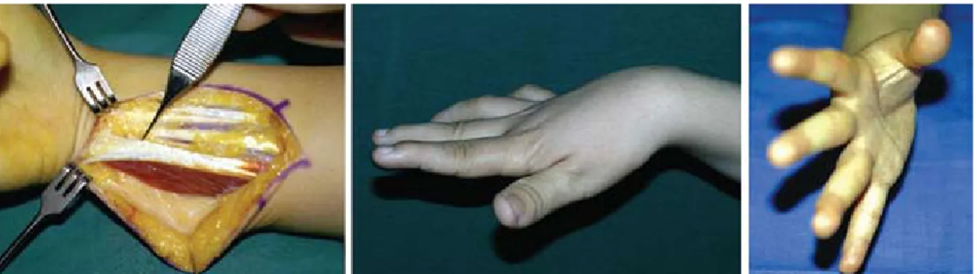 Fig. 8.  Green transfer. (Left) Access to the FCU tendon is through an incision on the volar ulnar side of the distal forearm