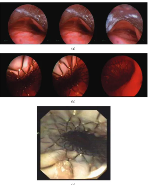 Figure 2: Pictures of stent during the rigid bronchoscopy procedure. Increase in trachea transverse diameter and severe malacia (a), trachea after stent placement (b), control visit at 1st month (c).