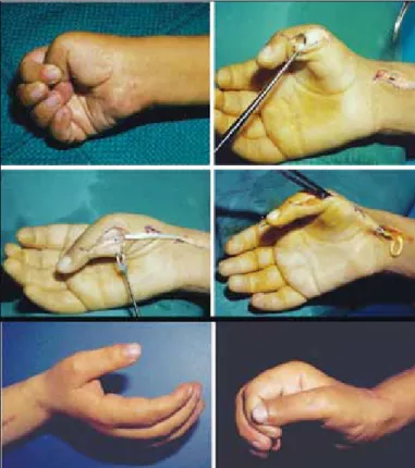 Figure 11. Correction of thumb-in-palm deformity with FPL abductorp-