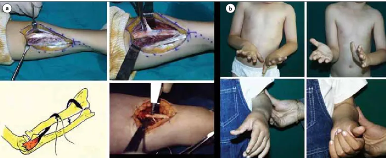 Figure 2. Pronator teres re-routing-Surgical technique: The forearm is brought to maximum supination and the pronator insertion at mid-1/3 radius 