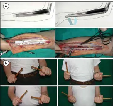 Figure 4. a)Transfer of the brachialis muscle to the re-routed biceps tendon– Surgical technique: The brachialis muscle is completely separated 