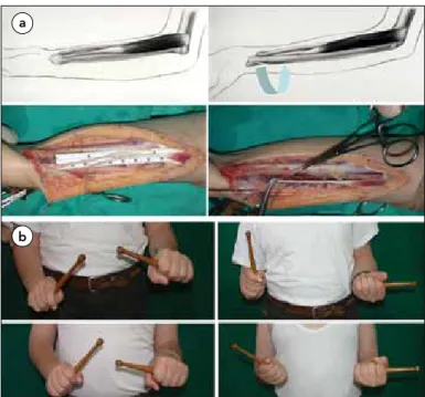 Figure 4. a)Transfer of the brachialis muscle to the re-routed biceps tendon– Surgical technique: The brachialis muscle is completely separated 