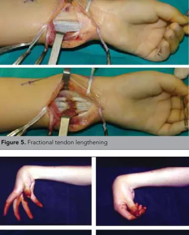 Figure 5. Fractional tendon lengthening