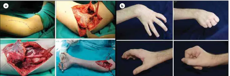 Figure 7. a. Flexor/Pronator Slide: Surgical technique b)Flexor/Pronator Slide: Sample Case: Preoperative (upper row) and postoperative (lower 
