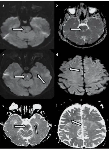 Figure 2. MR images of case 2(patient number 13). (a) Hyperintense lesion of 