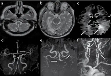 Figure 3. MR images of case 3 (patient number 4). (a-b) T2 MRI shows chron-