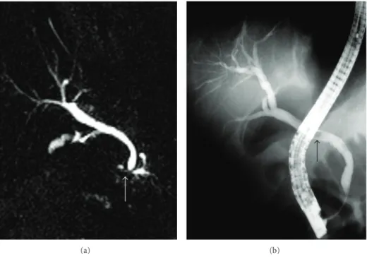 Figure 2: MRCP image demonstrates (a) a calculus (white arrow) located in the distal common bile that does not cause bile duct dilatation