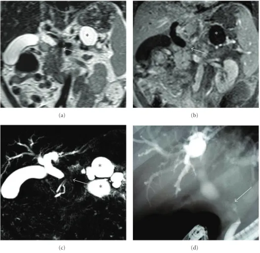 Figure 4: T2-weighted (a), contrast-enhanced T1-weighted MRI (b), and MRCP slices demonstrate significant stenosis in the common bile duct at the level of pancreas head (white arrow) and bile duct dilatation proximal to the stenosis
