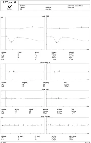 Figure 6: Her electroretinogram showed decreased scotopic a  and b-wave amplitudes and the photopic a and b wave, 30  Hz flicker amplitudes were severely attenuated.