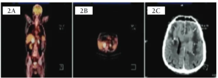 Figure 2: The images of PET-CT and Cranial MR.