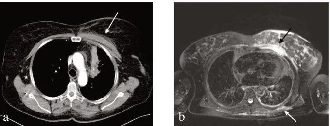 Figure 2. CT scan (a) and MR scan (b) of the thorax showing marked thickening of the pectoral and dorsal paras- paras-pinal muscles.