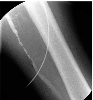 Figure 1.  Peripheral  angiography  image  demonstrates  a  critical  long  segment  stenosis  of  the  superficial  femoral  artery  with  an  irregular  border