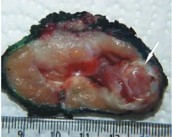 Figure 1. Macroscopic view of prostate rhabdomyosarcoma 