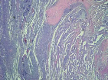Figure 2. Microscopic evaluation of prostate rhabdomyosarcoma. 