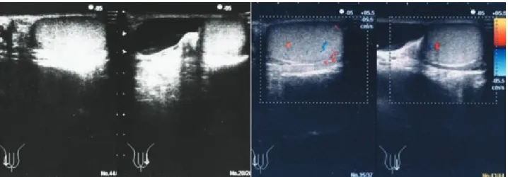 Figure 1. Left, Scrotal ultrasonography demonstrates a cystic lesion adjacent to the left testicle