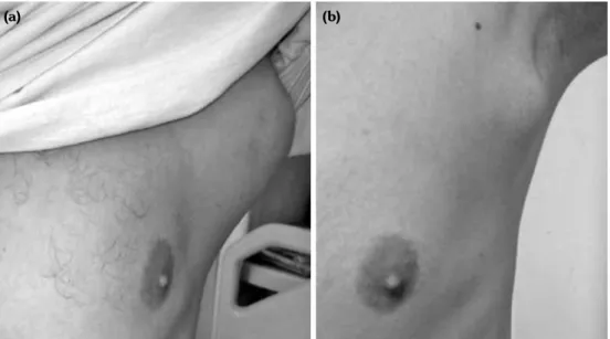Figure 1. (a) The initial presentation of the axillary mass. It was firm, fixed, painless, with no  pigmentation or ulceration