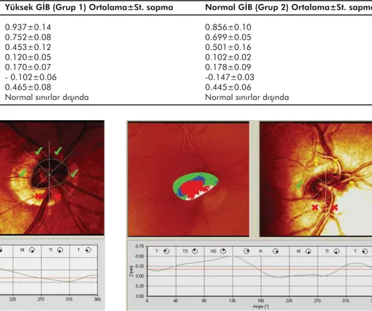 Tablo 2: Normal GİB ve yüksek GİB olan eğik diskli hastaların optik disk başı parametrelerinin HRT 2 ile karşılaştırılması