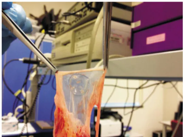 Figure 4 After the application the excessive tissue which was extended beyond the CL was cut with a scalpel.