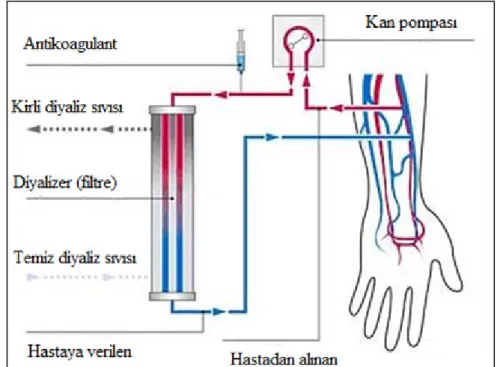 Şekil 4.1.Hemodiyaliz tedavisinin şematik gösterimi. 