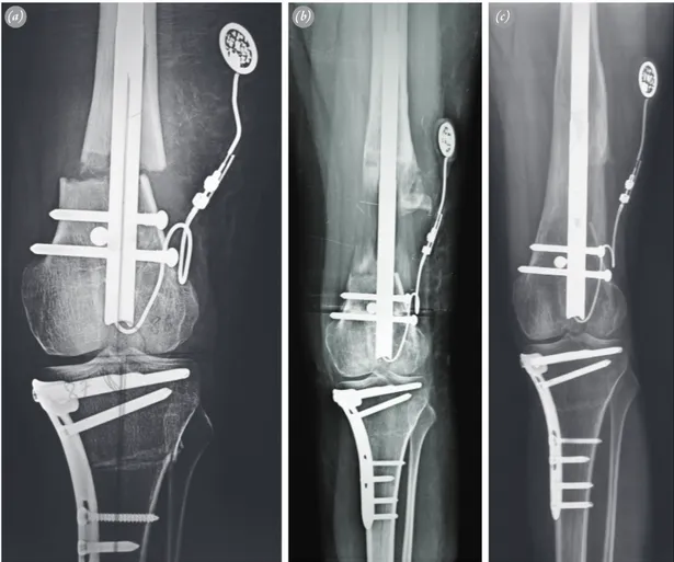Fig. 1.  A 15-yr-old female with angular deformity and 8-cm shortening of the left femur accompanying a deformity of the 