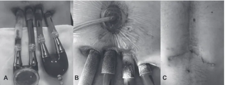 Figure 1. A) Berlin Heart EXCOR Biventricular Assist Device with four driveline exit sites