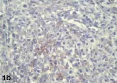 Figure 1B. Immunhistochemical staining (x40): Tumour cells showing  