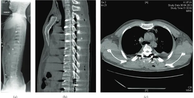 Figure 2: Contusion of the trachea at the carina level by the right T3 pedicle screw.