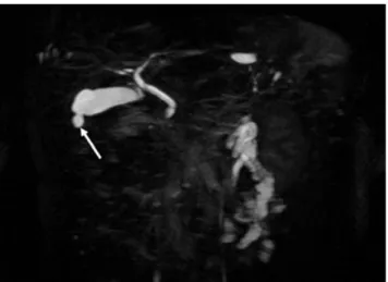 Figure 1 Coronal MRCP image of the abdomen. The T2-weighted fat