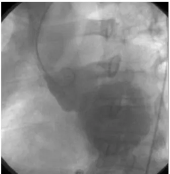 Fig. 1 Cardiac catheterization shows severe aortic regurgitation.