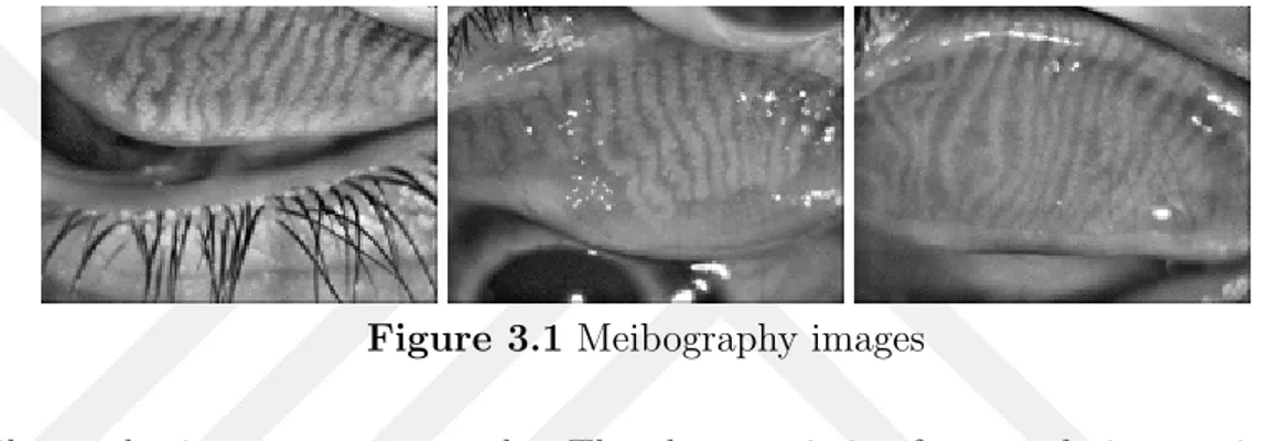 Figure 3.1 Meibography images