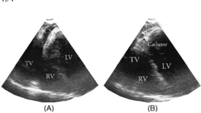 Figure 1. (A) TEE 0° image showing CS. (B) TEE 0° image showing the CS catheter with in the lumen of the CS