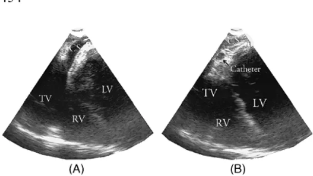 Figure 1. (A) TEE 0° image showing CS. (B) TEE 0° image showing the CS catheter with in the lumen of the CS