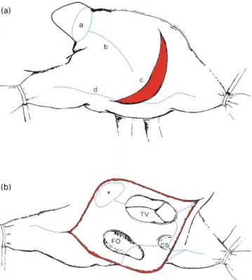 Fig. 4. (a) Ablation lines performed in the right atrium are shown. (a) Isolation of the right atrial appendage