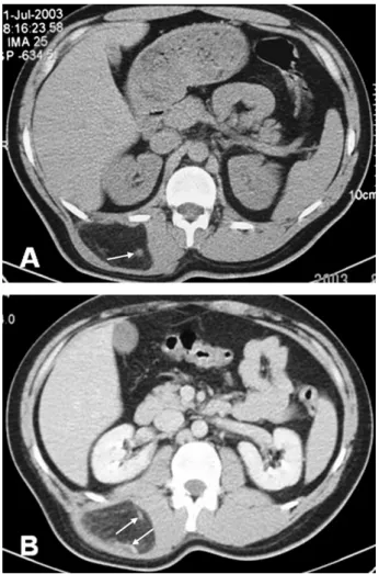Fig. 2. Patient 2. (A) On unenhanced CT images, the lesion is slightly hyperdense compared with subcutaneous fat; also, vascularity is detected inside the mass (arrow)