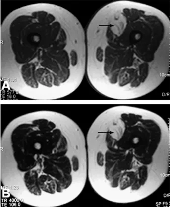 Fig. 4. Patient 4. (A) T1-weighted axial image shows a mass which isointense with subcutaneous fat also containing internal septations (arrow)