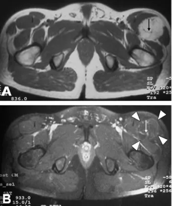 Fig. 6. Patient 6: (A) T2-weighted axial image shows a mass with internal septations slightly hypointense compared with subcutaneous fat