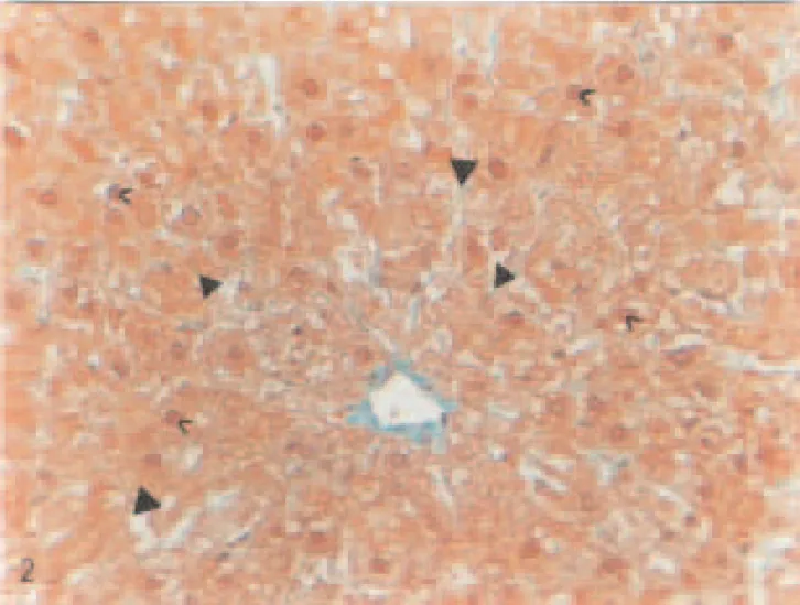 Fig. 2. Liver of a STZ-diabetic rat. Vacuolization ( ▲), pycnotic nuclei (&gt;), cytoplasmic granulation (&gt;), Masson’s tri-dye