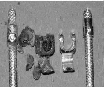 Fig. 3 Peroperative views of the metallosis before (A) and after (B) extraction of the materials