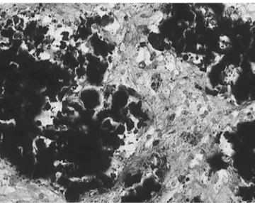Fig. 4 Iron staining by the Perls method showing widespread presence of iron (Perls ·200)