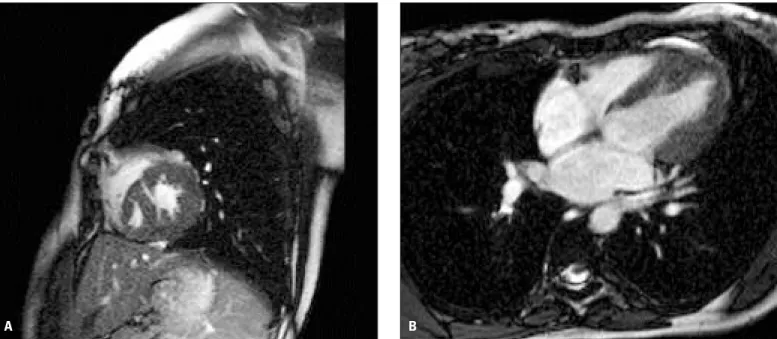 Fig. 2. Systolic phase dynamic MR images in sagittal (A) and axial (B) views show the diverticulum itself with  active systolic contraction