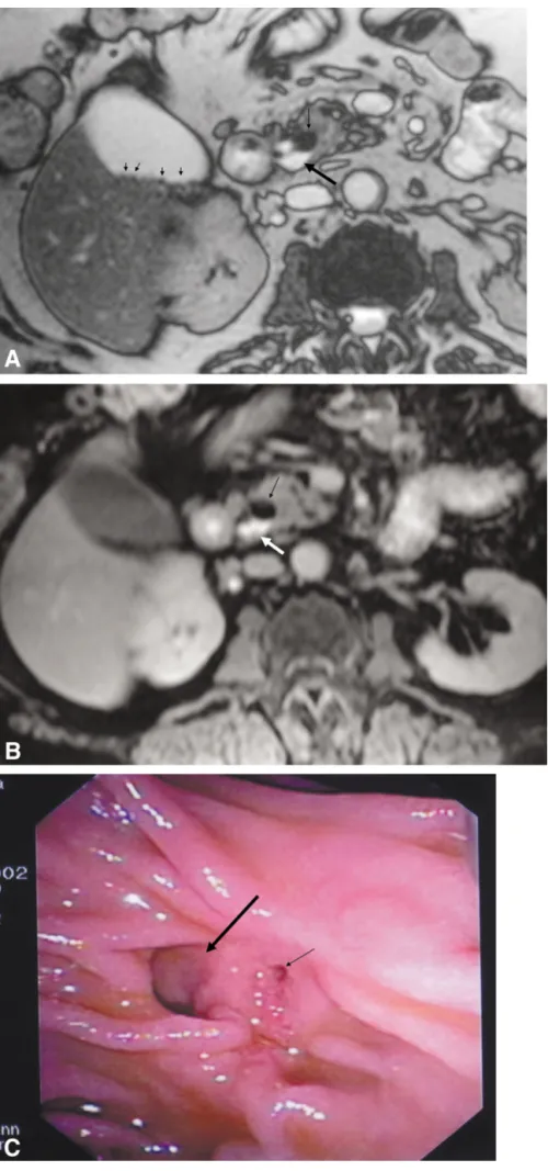 Figure 1. Small juxtapapillary divertic-