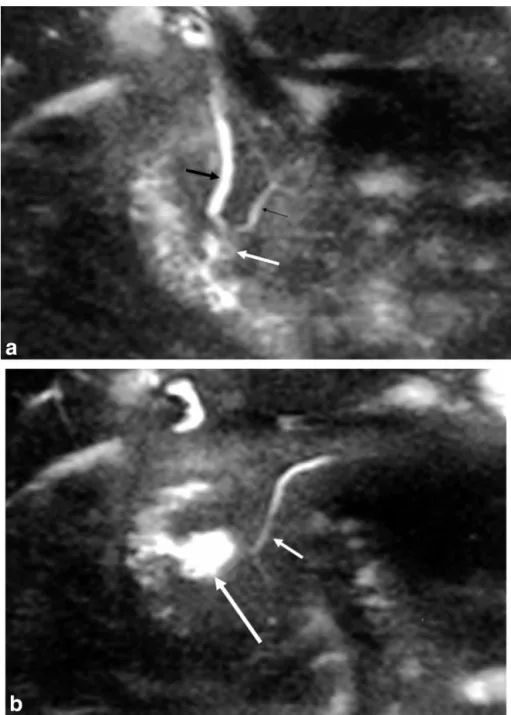 Figure 2. Juxtapapillary diverticulum